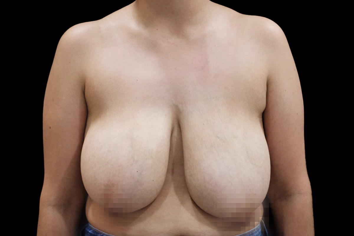 Antes Reduccion 2