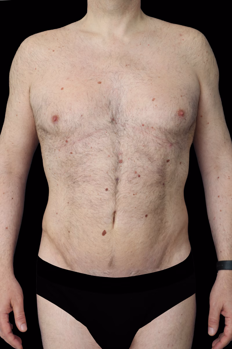 Lipectomia h des