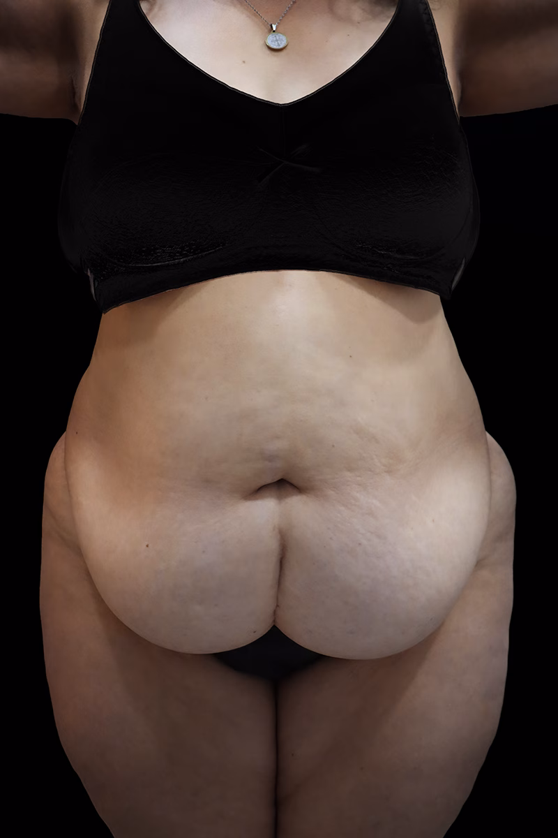 lipectomia lu antes