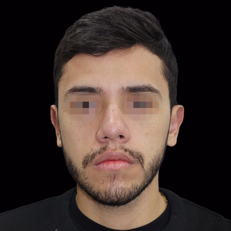 m despues 3