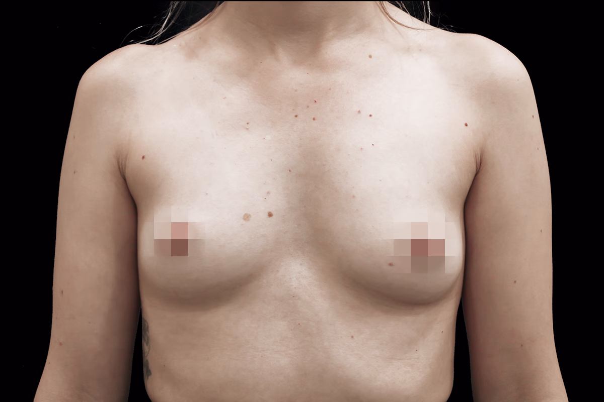 mamoplastia