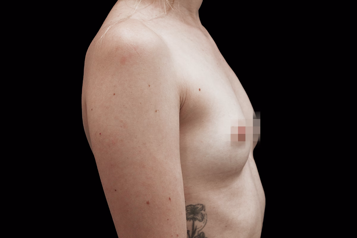 mamoplastia4