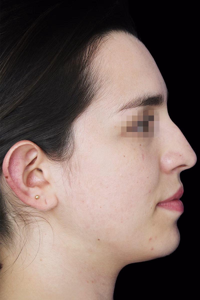 rinoplastia2 antes 2