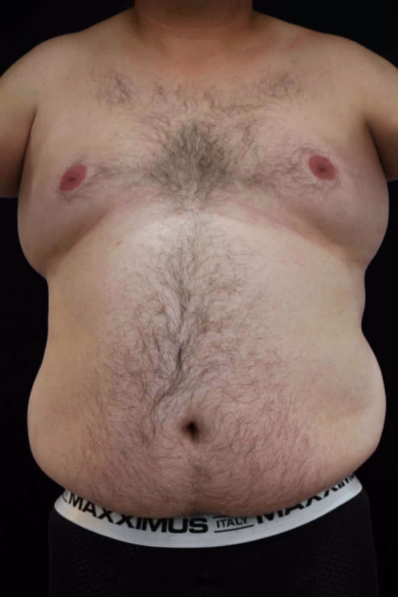lipecto hombres perea antes min