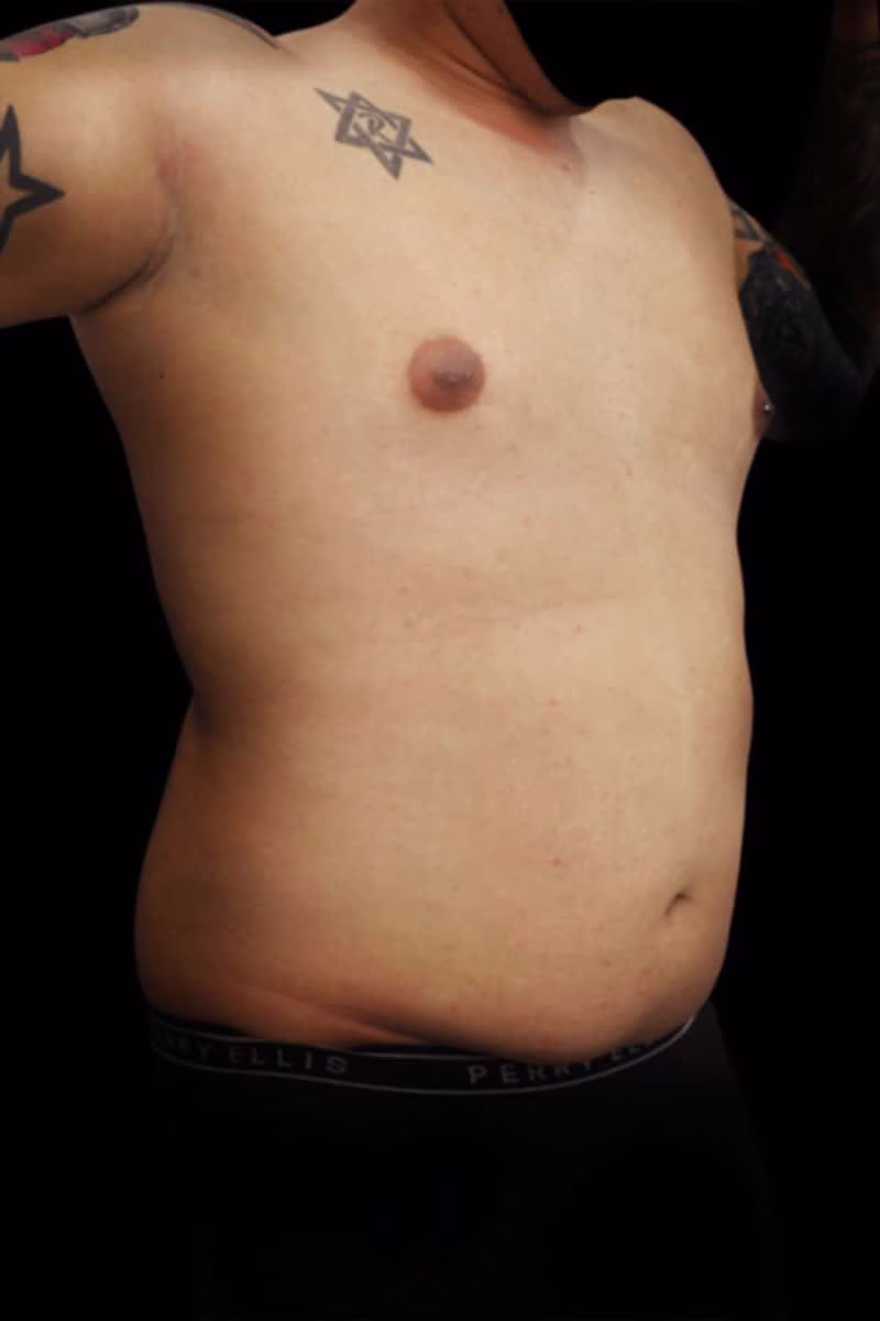 lipoescultura antes hombre perea min