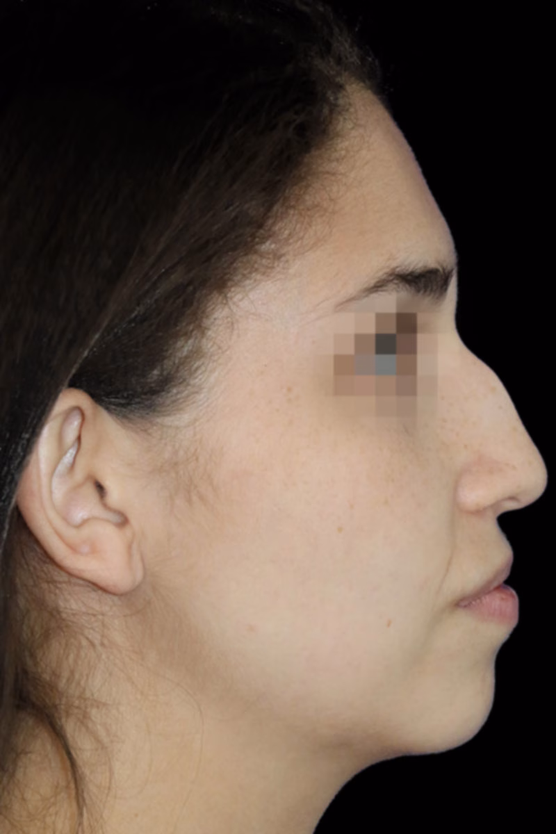 rinoplastia antes