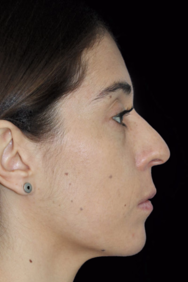 rinoplastia antes