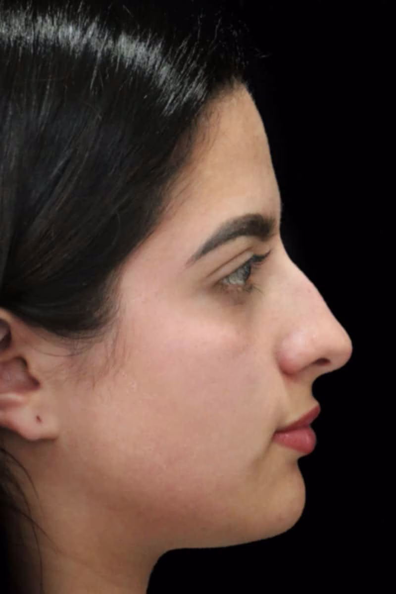 rinoplastia antes perea min