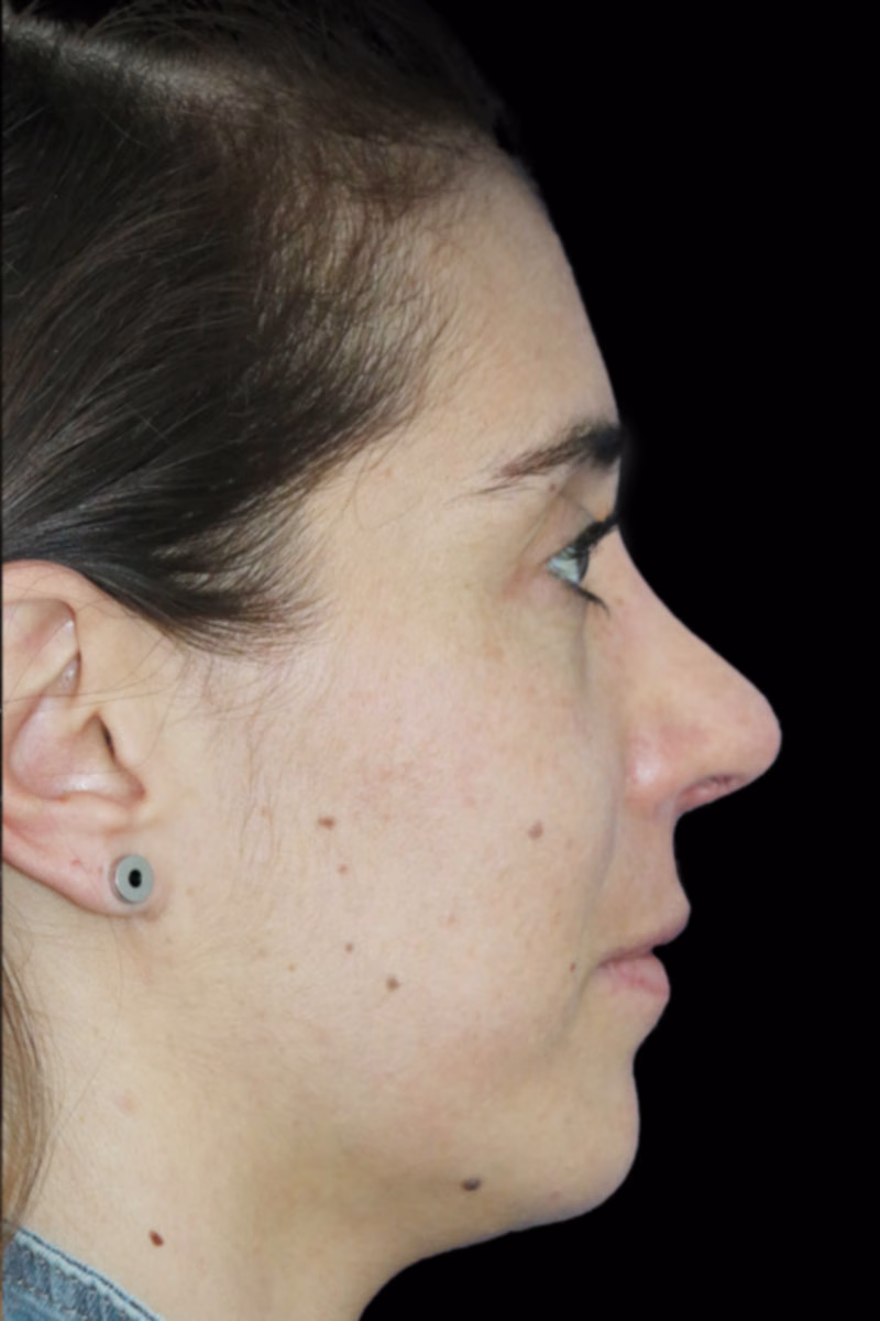 rinoplastia despues