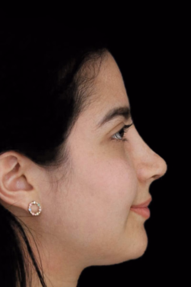 rinoplastia despues perea min
